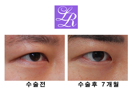 Can Epicanthoplasty Improve Facial Impression? Mongolian Fold Hook Correction image 3