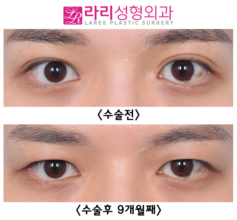 [Lari Plastic Surgery] Correcting Uneven Eyes with Forehead Botox After Double Eyelid Removal Surgery image 5
