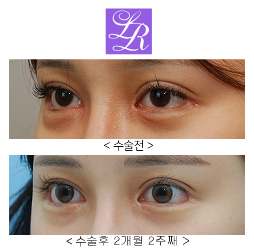 비절개눈매교정,눈꼬리내리기뒤트임 (졸린눈, 화난눈 교정) 관련 이미지 3