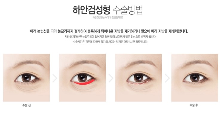 Upper Blepharoplasty and Lower Blepharoplasty image 4