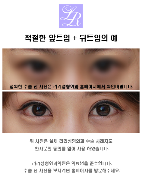 앞트임전후 많이 보면 도움이 될까 관련 이미지 3