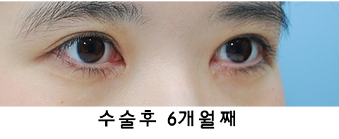 [라리성형외과] 절개쌍수 눈매교정 그리고 앞트임 관련 이미지 4