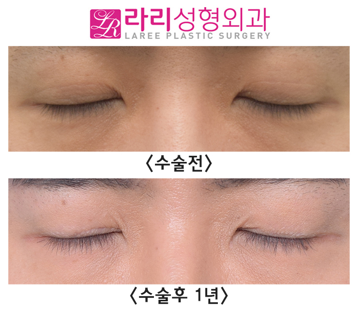 [Rari Plastic Surgery] Natural Double Eyelid Multiple Folds, Removing Them to Create a Monolid: Before and After Surgery After 1 Year image 4