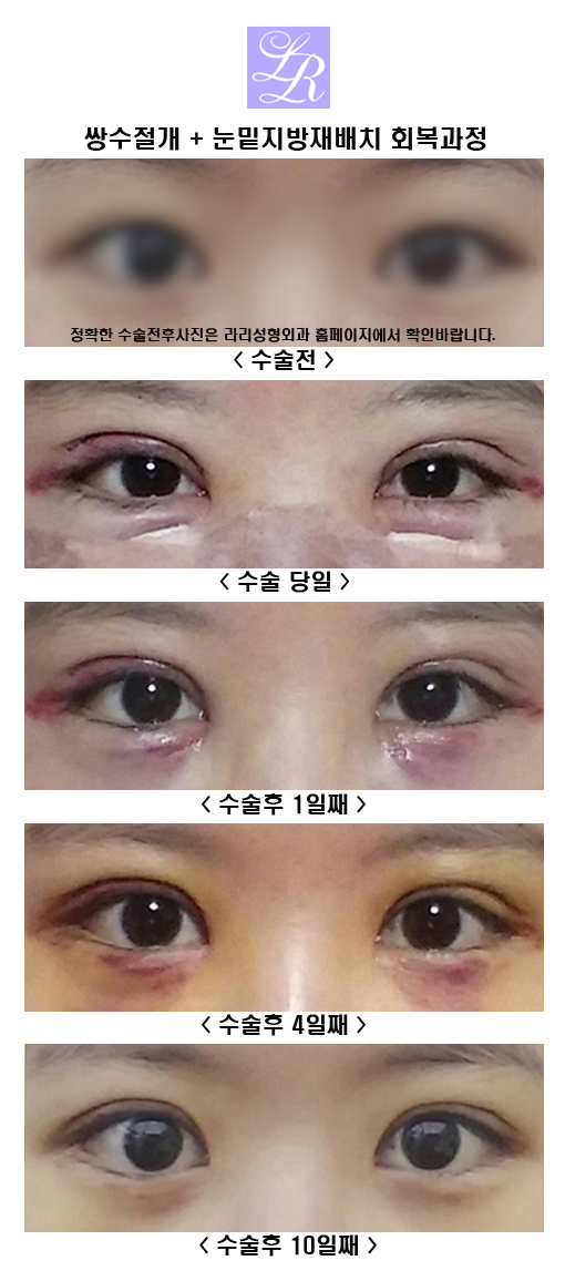 After Looking at Reviews of Incisional Double Eyelid Surgery image 4