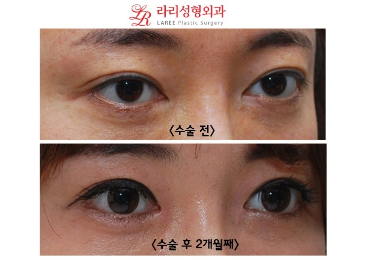 앞트임 복원 전후사진 (수술 2개월후와 1년후) 관련 이미지 2