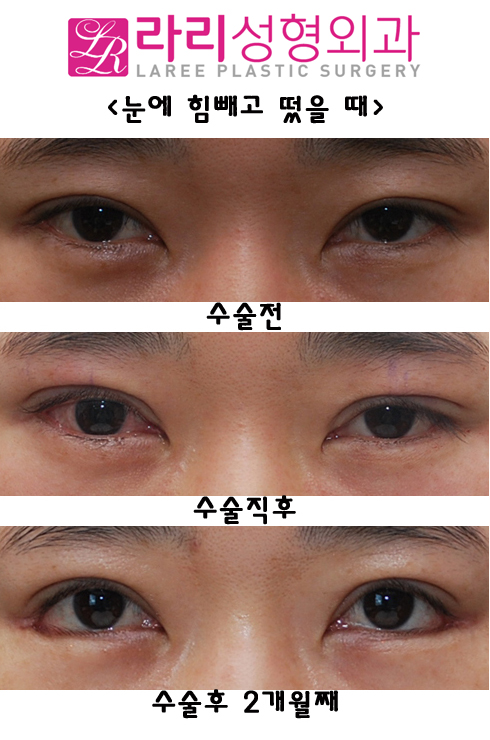 비절개눈매교정술과 뒤트임재수술 함께 한다면 관련 이미지 1