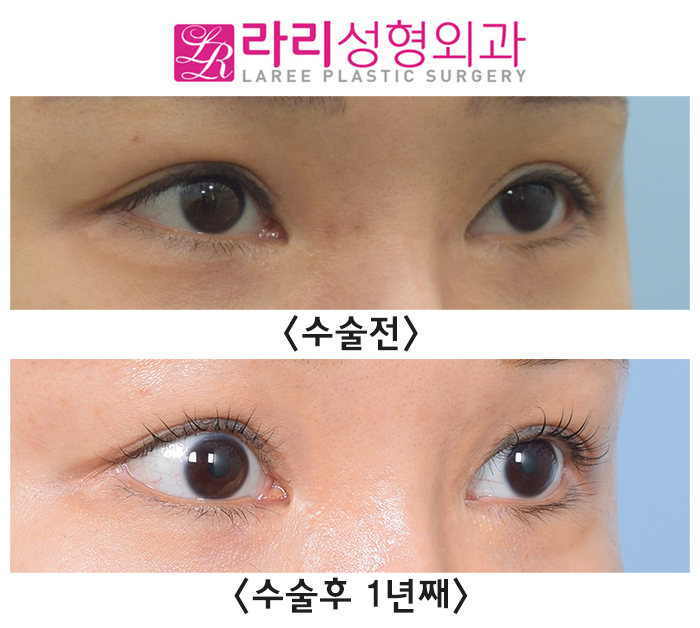 [라리성형외과] 수술 티 나지 않는 자연스러운 밑트임수술 전후 사진 관련 이미지 2