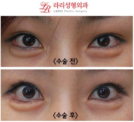 눈꼬리내리기뒤트임 장기경과 전후사진 관련 이미지 1