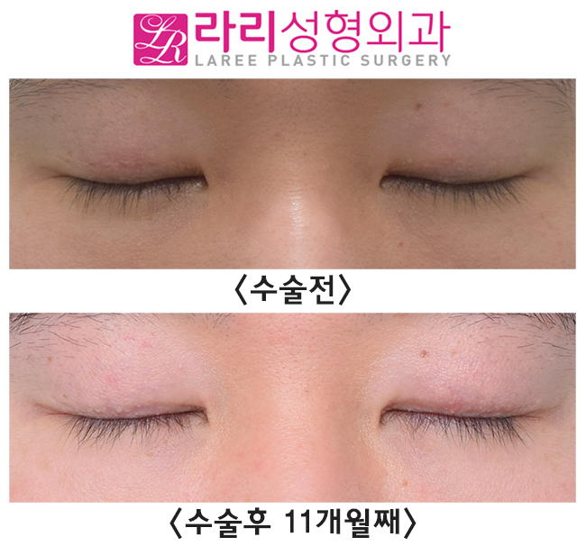 [Lari Plastic Surgery] Triple Set: Asymmetric Eye Correction + Ptosis Correction + Removing Double Eyelids! image 4