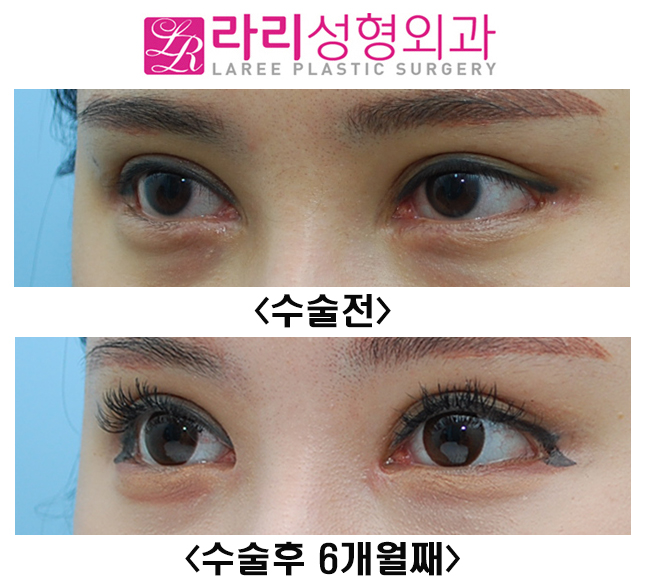 [라리성형외과] 적당한 앞트임 복원, 복원수술 전후 모양 관련 이미지 3