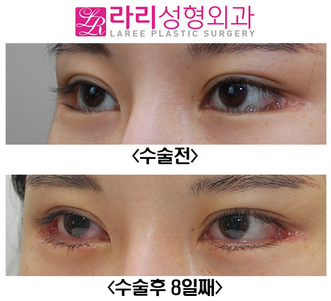 [라리성형외과] 속눈썹찔림, 안검내반교정수술이 필요할 때. 관련 이미지 2