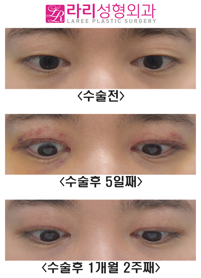 [라리성형외과] 여러겹 쌍꺼풀라인 없애기 관련 이미지 3