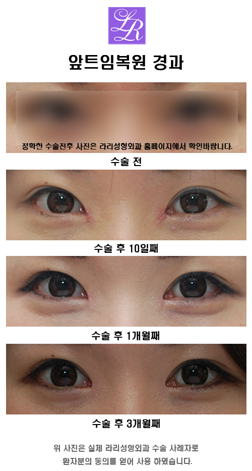 앞트임전후 - 과도한 흉터 생긴 경우엔? 관련 이미지 6