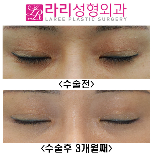 [Lari Plastic Surgery] Before-and-After Photos 3 Months After First Canthoplasty image 4