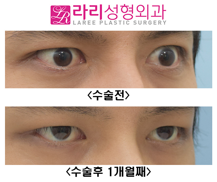 [라리성형외과] 눈크기 짝짝이 교정 수술 전후사진 관련 이미지 2