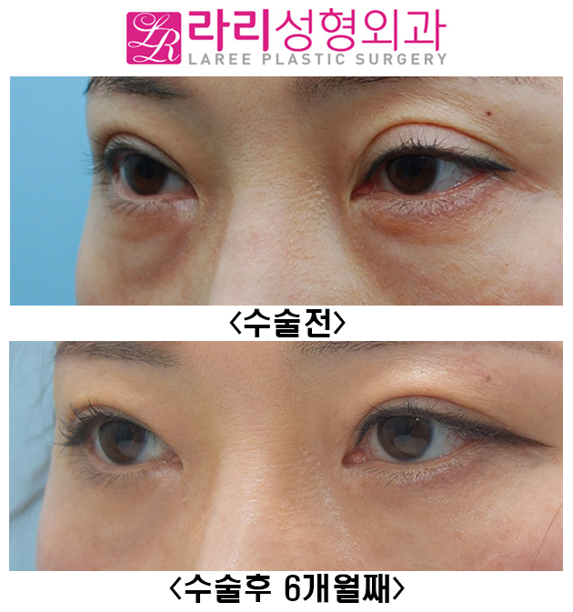 [라리성형외과] 쌍꺼풀재수술, 앞트임재수술, 눈밑지방재배치재수술 전후사진 관련 이미지 3