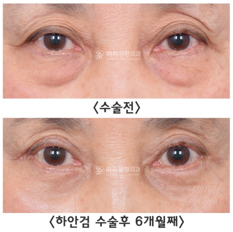 [라리성형외과] 하안검성형 VS 눈밑지방재배치(제거) : 어떤 수술을 해야 할까? 관련 이미지 4