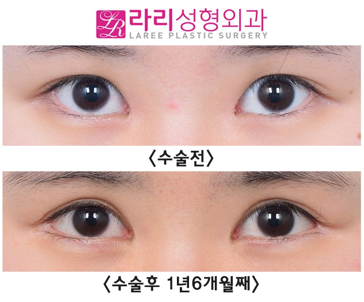 [Rari Plastic Surgery] Comparing the Before-and-After Effects of Lateral Canthoplasty Performed Together with Incisional Double Eyelid Surgery image 1