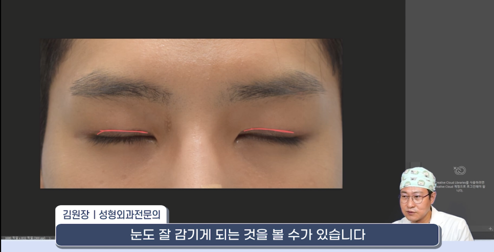[라리성형외과] 쌍꺼풀재수술 라인 낮추는 두 가지 수술법 (절제방법 , 두줄따기방법) 관련 이미지 10