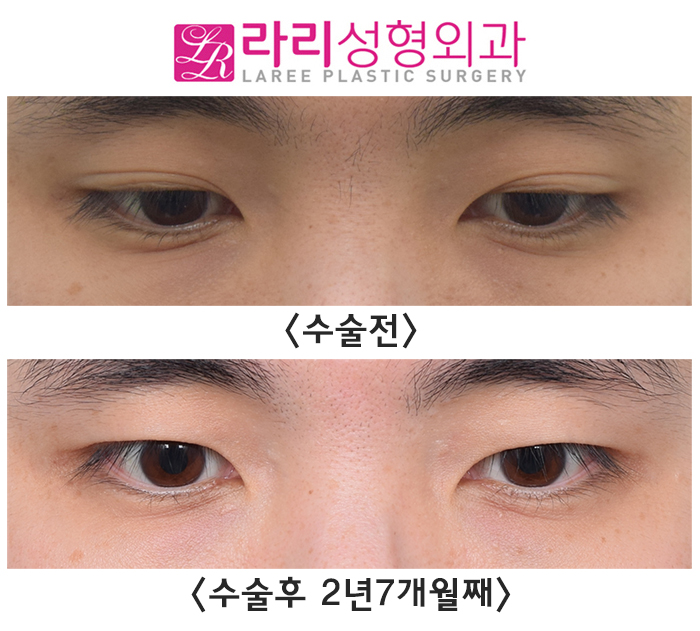 [Lari Plastic Surgery] Long-Term Before-and-After Photos of Surgery to Remove Double Eyelids and Create a Natural Single Eyelid Look image 4