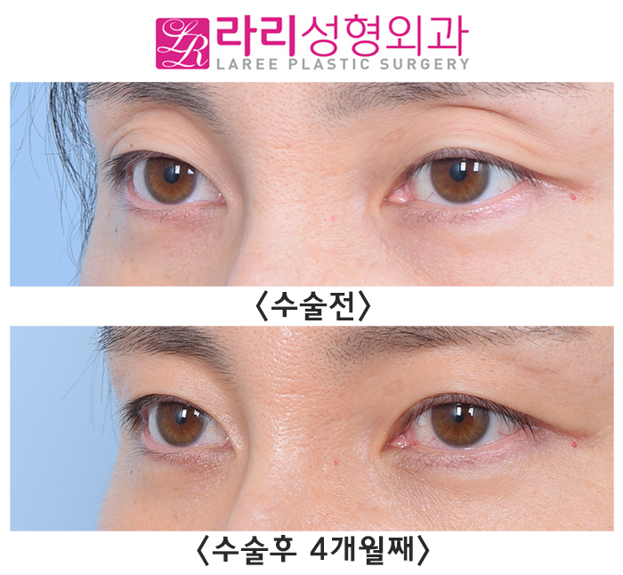 [Lari Plastic Surgery] For Improving Sunken Eyelids: Incisional Double Eyelid Surgery + Upper Eyelid Fat Grafting image 4