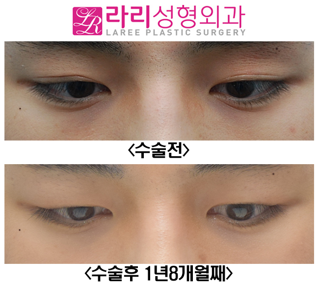 [라리성형외과] 쌍꺼풀없애기와 앞트임수술 전후사진 관련 이미지 3