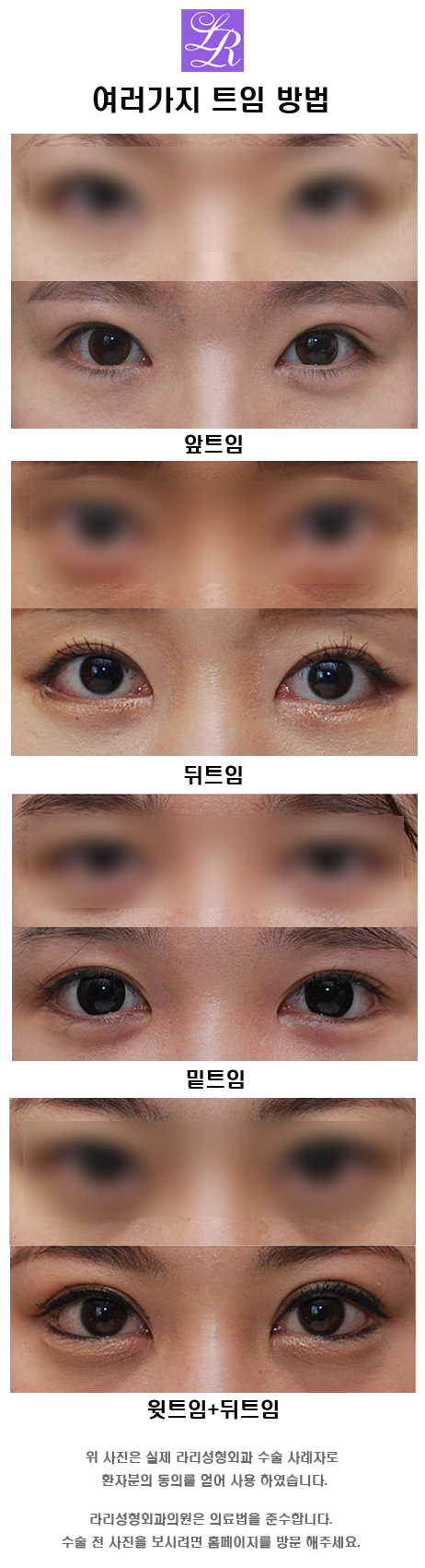 A Place with Many Reviews of Lower Eye Corner Surgery - Lari Plastic Surgery’s Tips for Maintaining the Effects of Lower Eye Corner Surgery! image 1