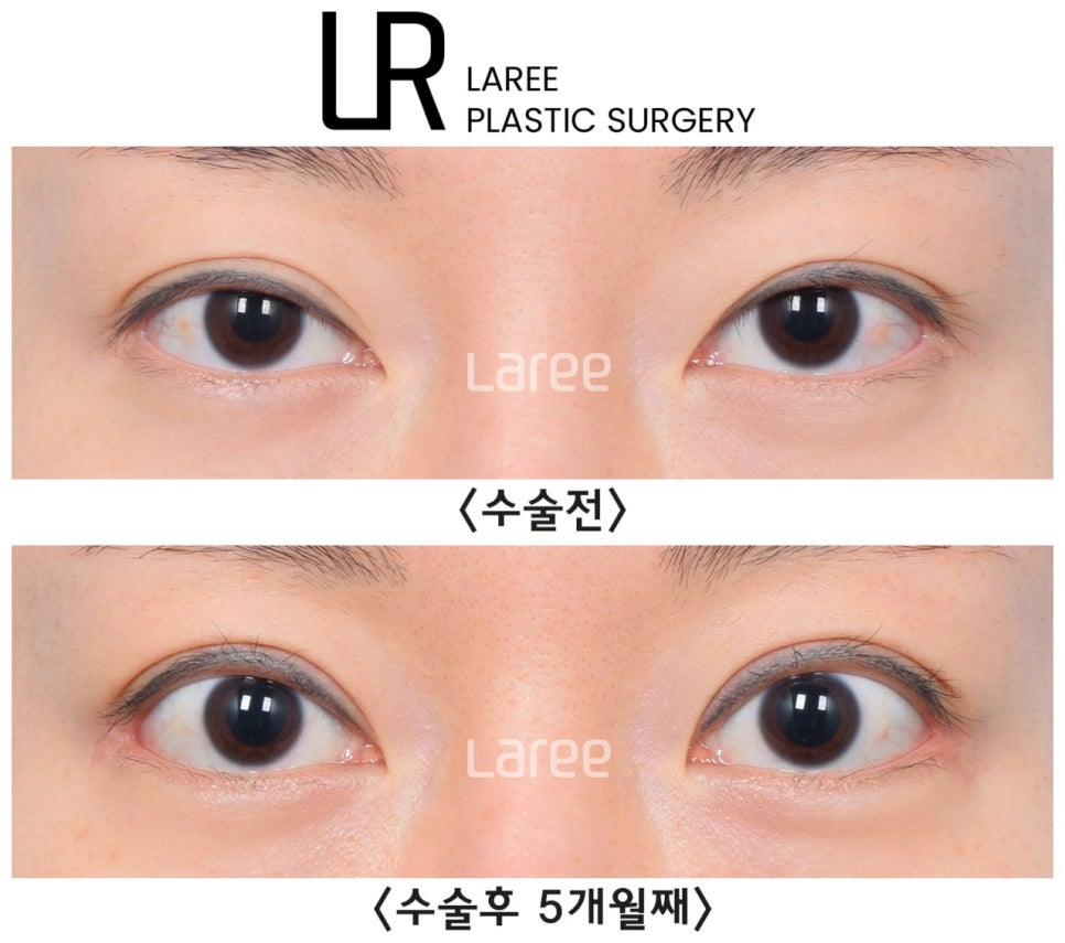 [Lari Plastic Surgery] The Real Way to Make Eyes Bigger: Eyelid Correction Surgery Is Needed Before Canthoplasty. image 6