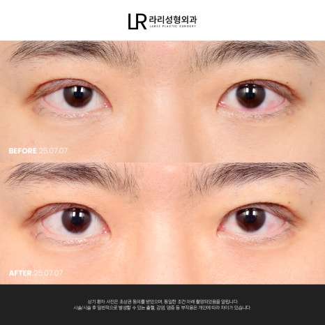 [라리성형외과] 눈 (재) 수술은 라리성형외과가 관련 이미지 4