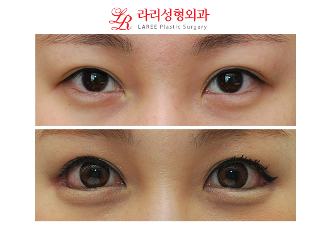 Before-and-After Photos of Eye Corner Lowering Lateral Canthoplasty image 1