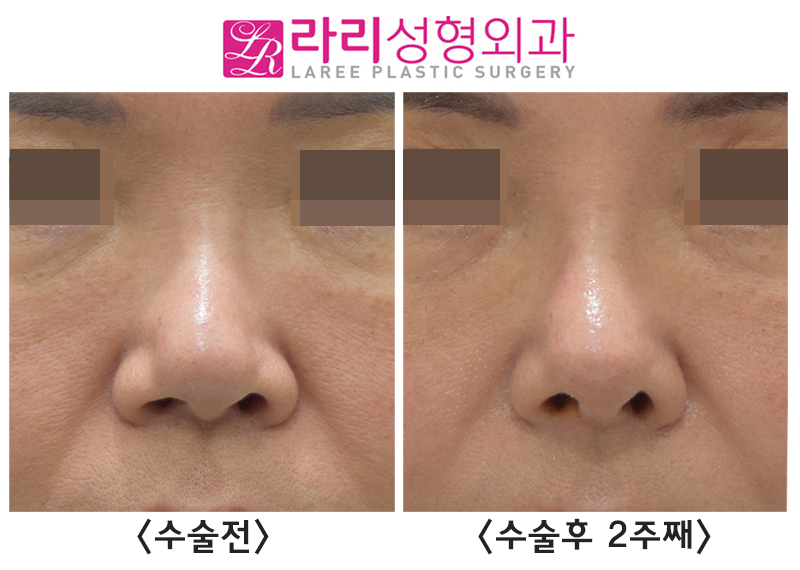[라리성형외과] 코재수술, 입툭튀를 개선하는 고양이수술 효과 전후 사진 관련 이미지 6