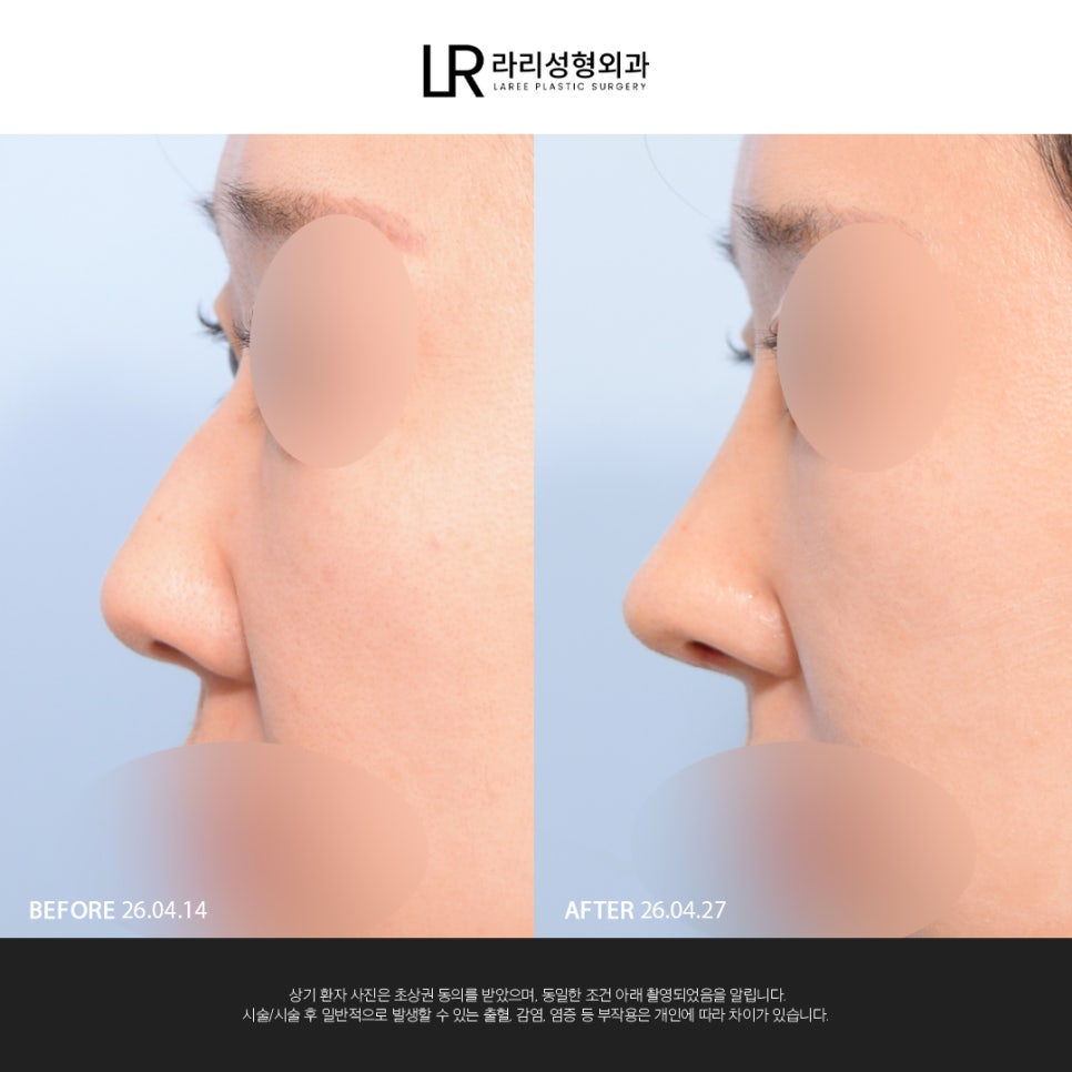 [Lari Plastic Surgery] If You Are Considering Nose Surgery, Do Not Get Nose Thread-Lifting Procedures Like Misko / Hiko!! image 5