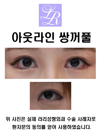 아웃라인 쌍수 높이에 대해 관련 이미지 3