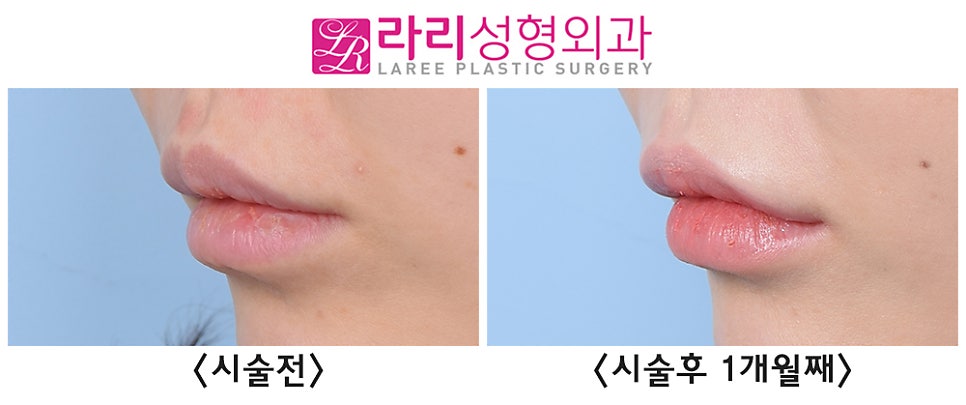 [라리성형외과] 1cc의 변화, 웃는 입모양 만드는 입꼬리 필러 전후 사진 관련 이미지 4