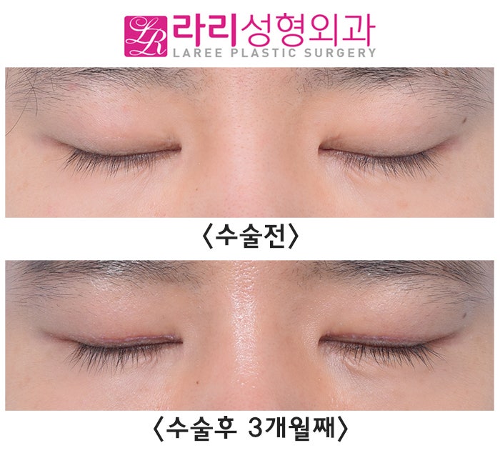 [라리성형외과] 눈매교정 부작용 토안 교정하면서 동시에 쌍꺼풀없애는수술까지 관련 이미지 4