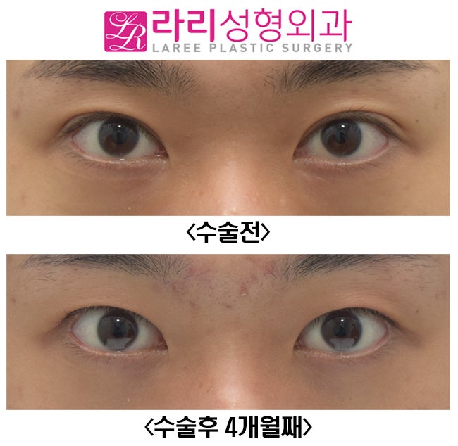 [라리성형외과] 쌍꺼풀없애기 그리고 눈두덩이 꺼짐 교정 (루프지방이식) 관련 이미지 3