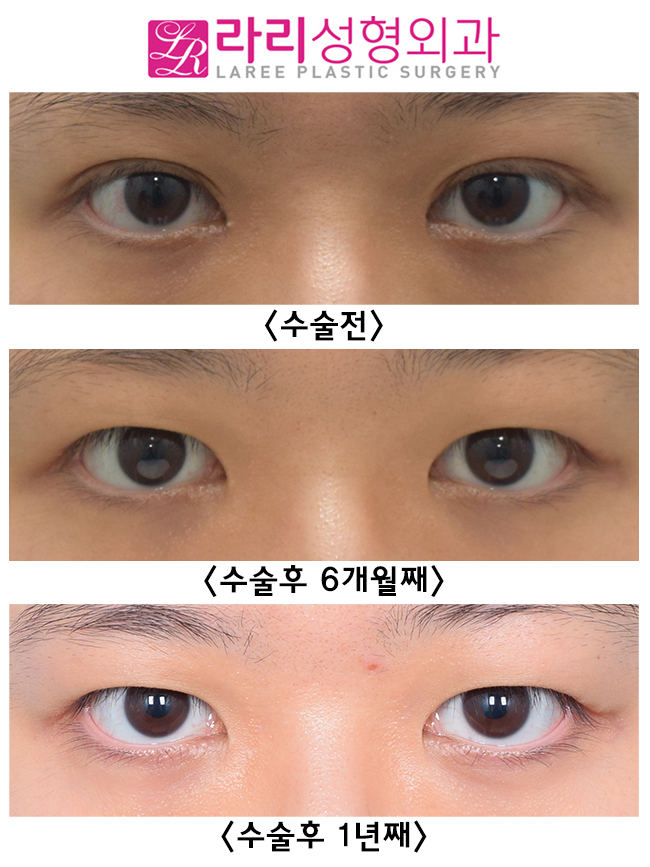 [라리성형외과] 재발률이 낮은 반영구 수술 쌍꺼풀없애기 관련 이미지 5