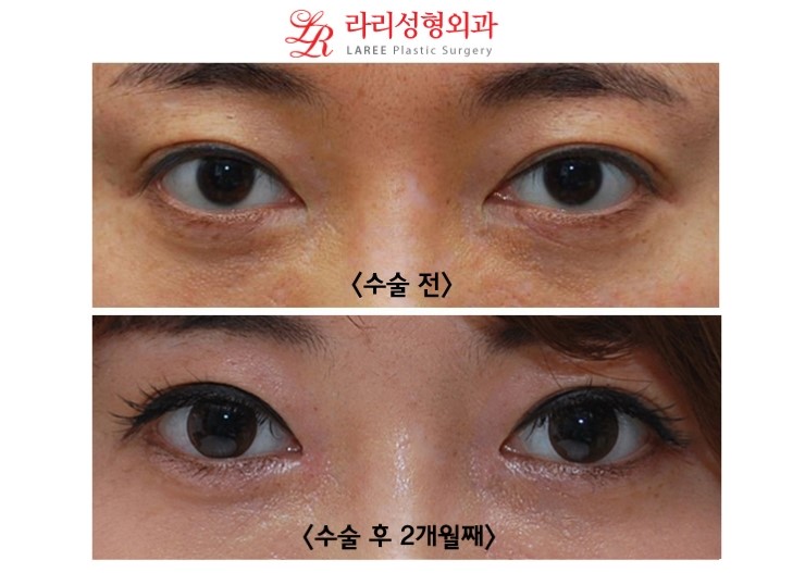 앞트임 복원 전후사진 (수술 2개월후와 1년후) 관련 이미지 1
