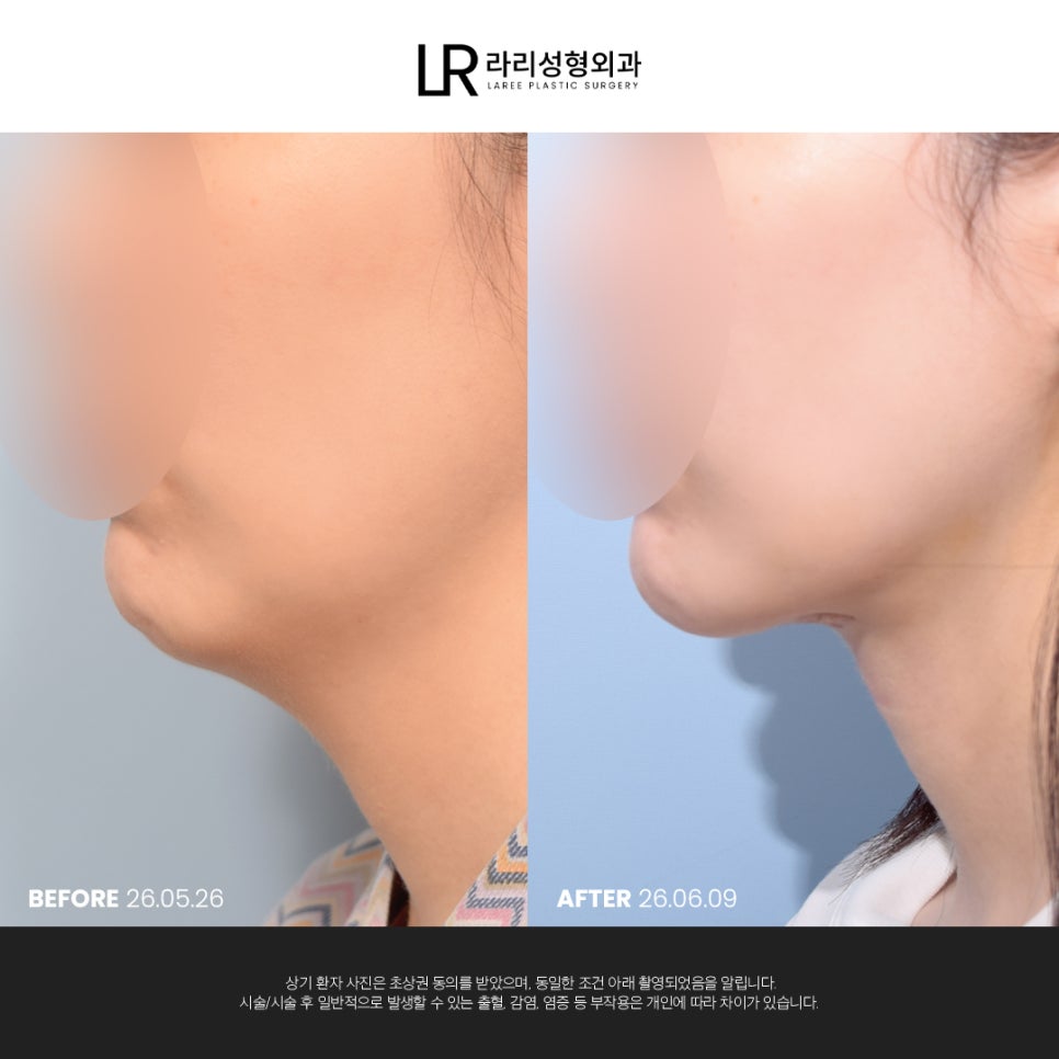 [라리성형외과] 이중턱 지방 흡입만으로는 아쉬운 얼굴 라인, 이중턱 근육 묶기도 같이 하면 효과가 두 배! 관련 이미지 3