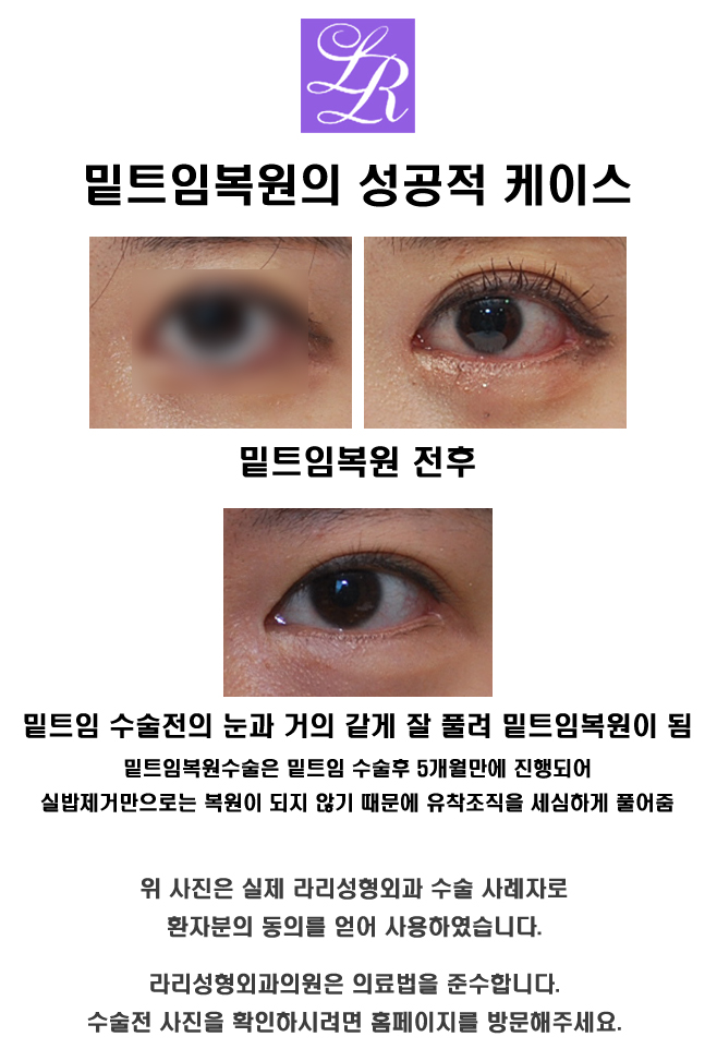 눈 밑트임 한것도 복원이 가능한가요? 관련 이미지 7