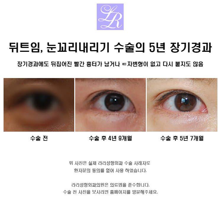 Detailed Explanation of the Principle of Lateral Canthoplasty and Eye Corner Lowering Surgery image 7