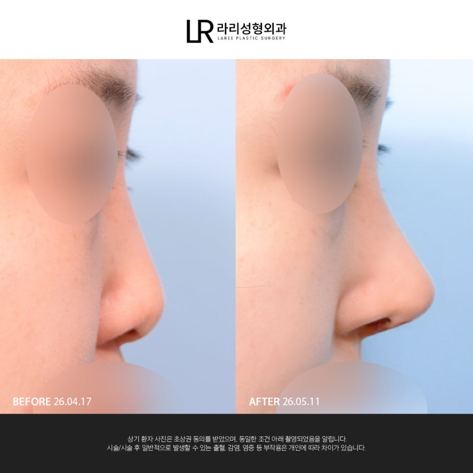 [Lari Plastic Surgery] If You Are Considering Nose Surgery, Do Not Get Nose Thread-Lifting Procedures Like Misko / Hiko!! image 1