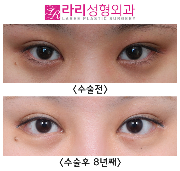 [라리성형외과] 단기 경과에 이은 뒤트임수술 8년 장기 경과 수술 전후 사진 관련 이미지 2