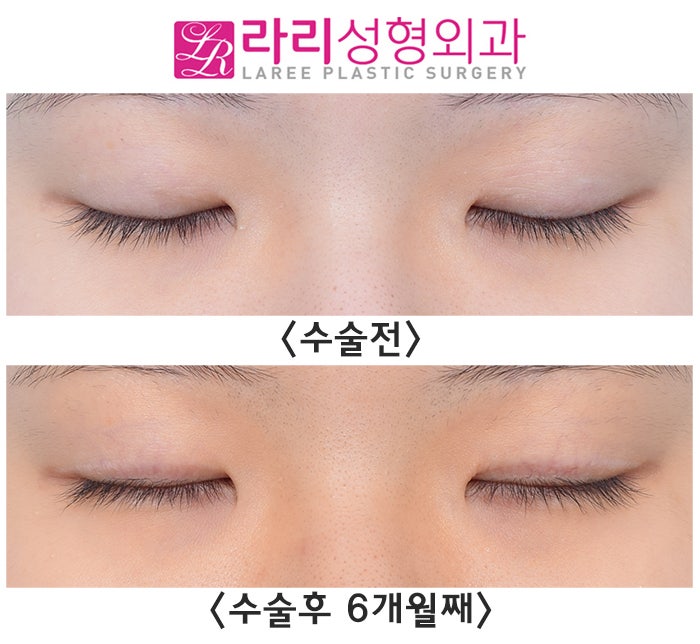 [라리성형외과] Revision Double-Eyelid Surgery if Buried-Suture Double Eyelids Come Undone? No, No—Removing the Double Eyelid! image 5