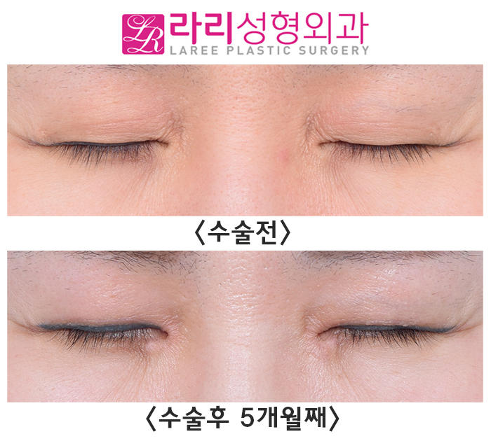[라리성형외과] 자연스러운 속쌍꺼풀 절개눈매교정, 앞트임수술 전후사진 관련 이미지 3