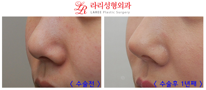 코재수술 잘하는곳 변화가 확실한 라리성형외과! 관련 이미지 1