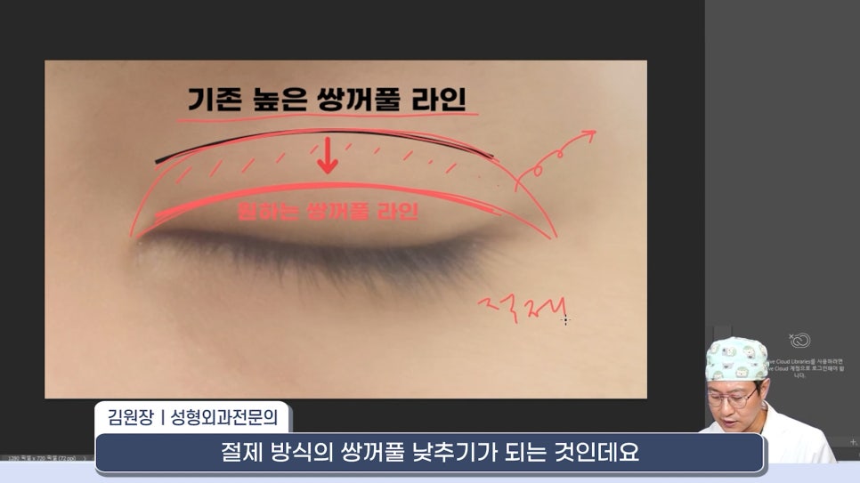 [라리성형외과] 쌍꺼풀재수술 라인 낮추는 두 가지 수술법 (절제방법 , 두줄따기방법) 관련 이미지 1