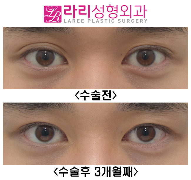 [라리성형외과] 자연 짝눈, 속쌍꺼풀 쌍꺼풀없애기로 짝짝이교정 관련 이미지 1