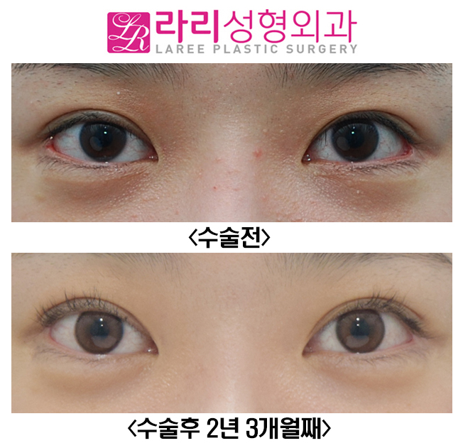 [라리성형외과] 최소한의 뒤트임 복원수술로 최대한의 효과를(+쌍수 짝짝이 교정) 관련 이미지 4