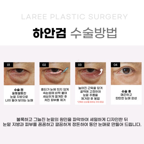 [라리성형외과] 하안검성형 VS 눈밑지방재배치(제거) : 어떤 수술을 해야 할까? 관련 이미지 8